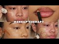 MAKEUP THERAPY 4 (ACNE, RAW & UNFILTERED) *SATISFYING* | SAMANTHAEVIRA