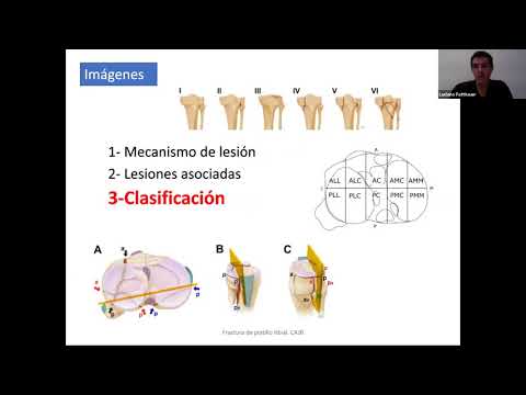 PRINCIPIOS QUIRURGICOS EN FRACTURAS DE PLATILLOS TIBIALES