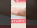 疥癬(かいせん)とはどんな病気!?#千里中央花ふさ皮ふ科 #疥癬 #shorts