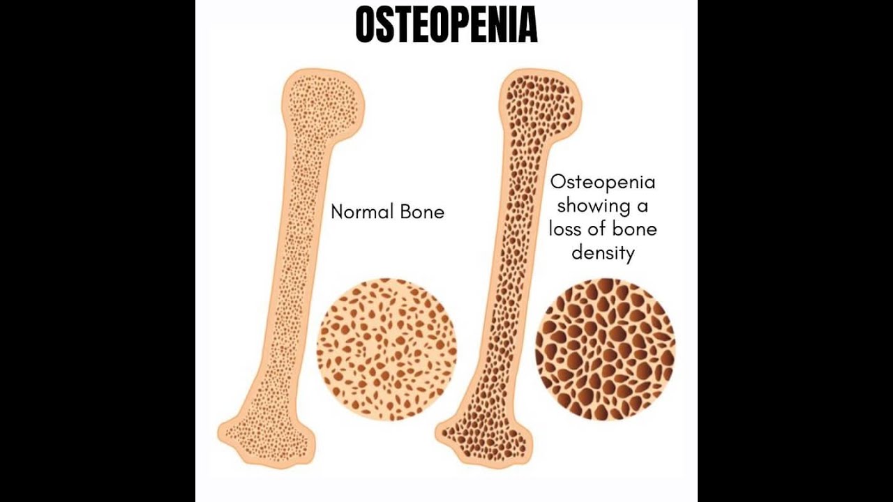 Osteopenia Tibia Osteopenia - YouTube