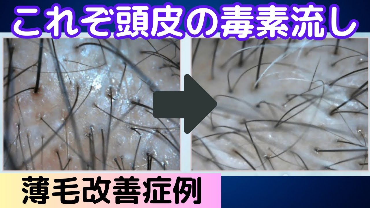 頭皮マッサージ前に2分プラスするだけで育毛効果爆上げ！老廃物を排出