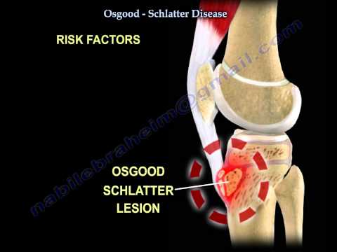 Osgood Schlatter Disease - Everything You Need To Know - Dr. Nabil Ebraheim