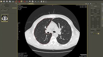 Lung Lub Segmentation Using Propagation in Weasis