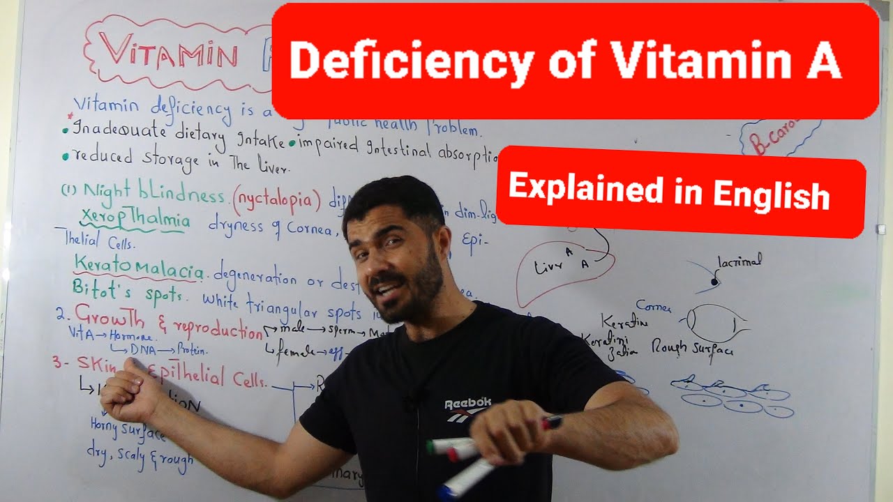 Deficiency Of Vitamin A explained in English by Dr. Hadi - YouTube