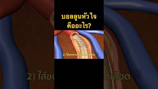 บอลลูนหัวใจ คืออะไร? #หมอหัวใจ #บอลลูนหัวใจ #โรคหัวใจ #โรคหัวใจและหลอดเลือด #ใส่บอลลูน #shorts บอลลูนหัวใจ คืออะไร? #หมอหัวใจ #บอลลูนหัวใจ #โรคหัวใจ #โรคหัวใจและหลอดเลือด #ใส่บอลลูน #shorts