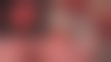 2 Grafting autogenous bone with Your3Dcage   HD 1080p