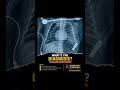 Diagnosis?#pediatrics #neetpg #mbbs #emergencymedicine #fmge #xray #cardiology  @DrHardeepPeads