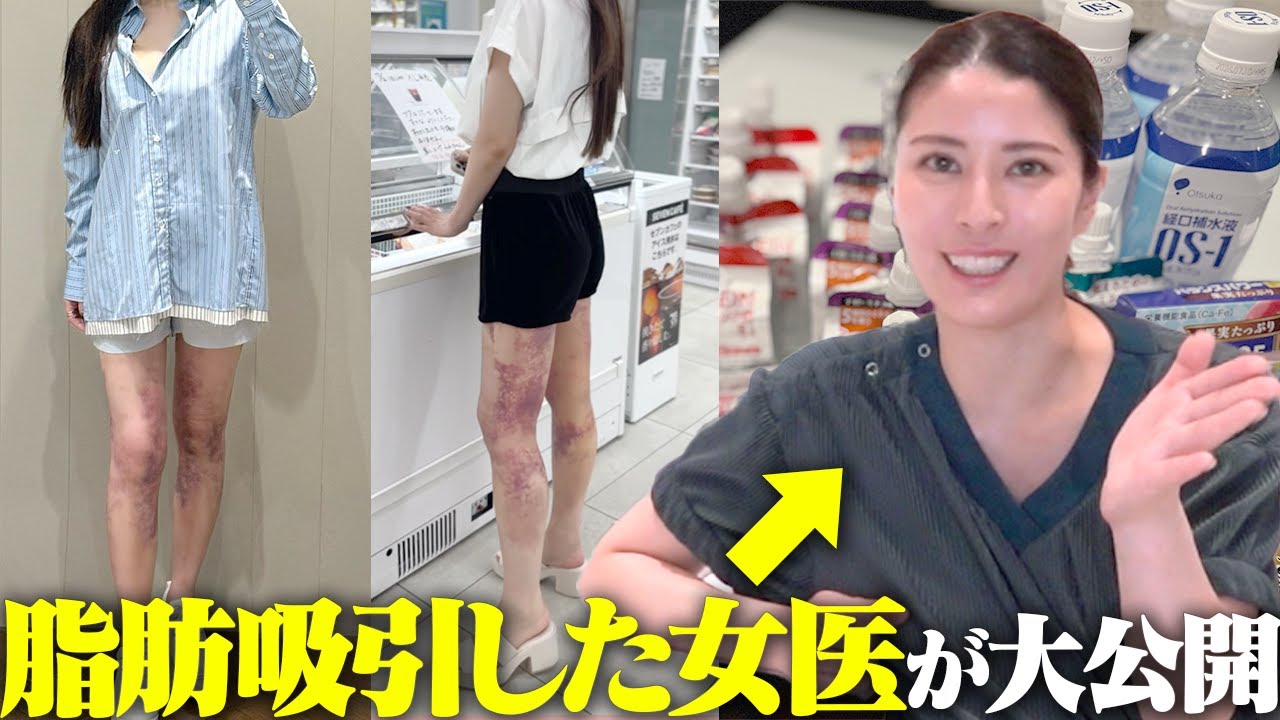 【これだけは用意して！】事前説明じゃ教えてくれない脂肪吸引の全てを女医が徹底解説✨【モッズクリニック】