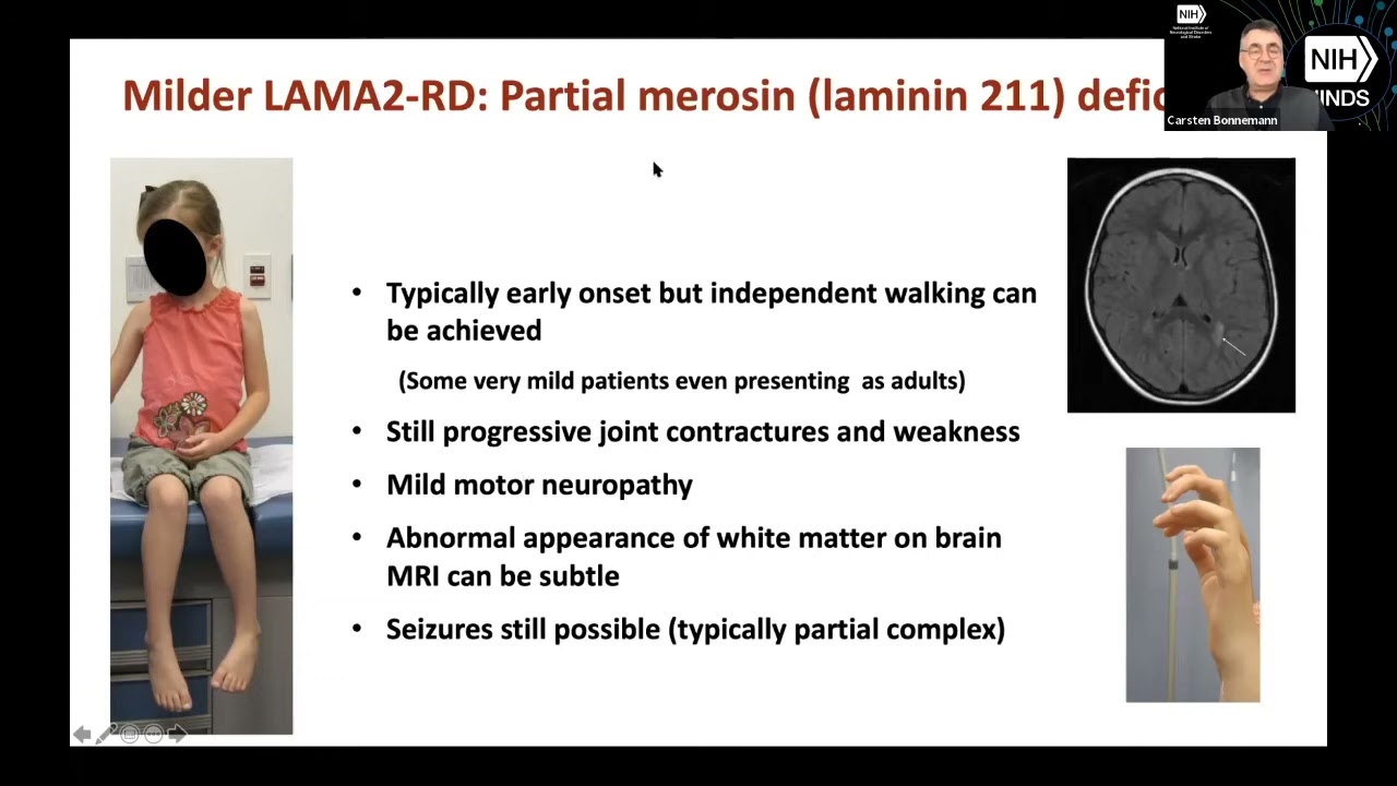 Lecture by Dr  Carsten Bönnemann | International Conference on LAMA2-CMD 2019