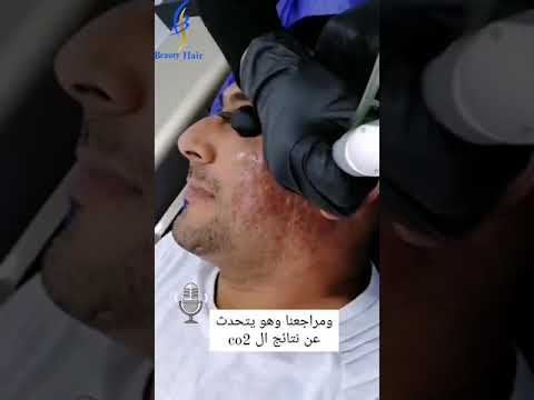 جلسة فراكشنال ليزر