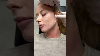 Jawline dermal filler treatment | Patient’s first time | Dr Bart performs cannula treatment Resimi