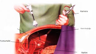 Laparoskopi - Op. Dr. Emre Karatekelioğlu