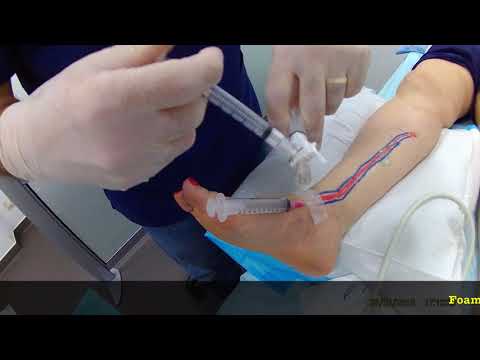 Video: Prosedur Sclerotherapy Vena