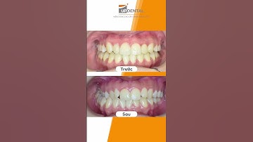 Hành trình LỘT XÁC nhờ niềng răng của Hoàng Linh  #updental #braces