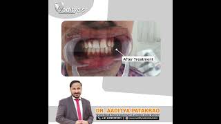 Dental Emergency Emergency Dental Treatment With Dr Aaditya Prevent Dental Emergencies 