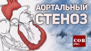 Аортальный стеноз.