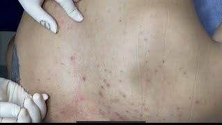 ACNE TREATMENT WITH VU QUYNH MI | Acne Squeeze on Back Resimi