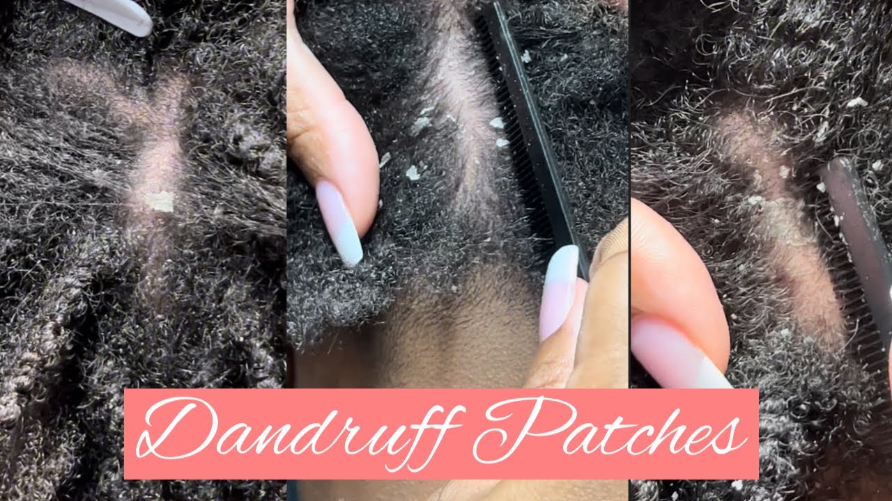 Happy Saturday😀 Dandruff Patches Dry Itchy Scalp youtuber dandruff