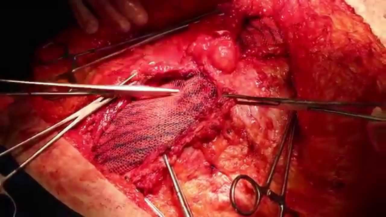 Dermolipectomia com herniorrafia incisional / Dermolipectomy doutor estranho filme
