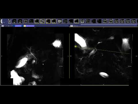 How to read an MRCP