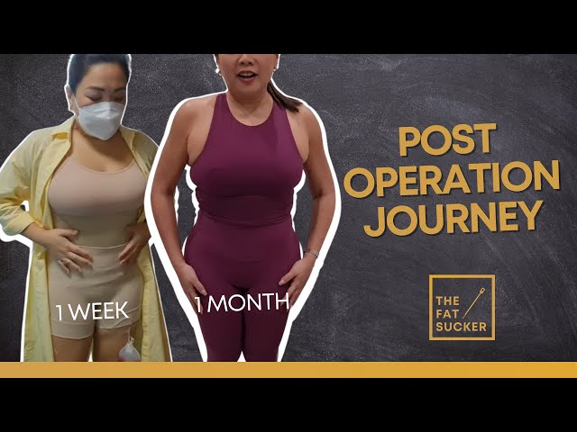 The Fat Sucker: Dr. Claudine Roura- Patient's Post Operation Journey 
