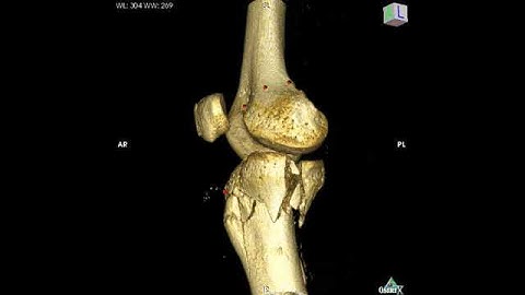 X-Ray Computed Tomography of Knee