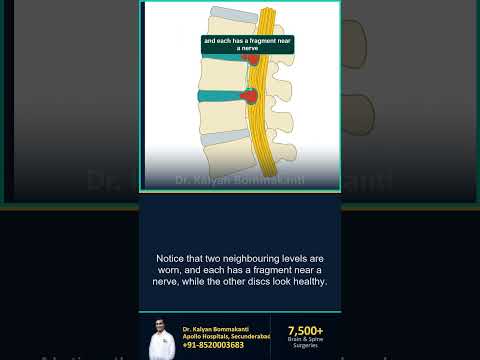 Two Slipped Discs? Worn Isn't the Same as Painful — Best Endoscopic Spine Surgeon, Hyderabad