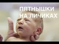 Пятнышки на лицах новорожденных II ОВП