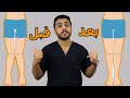 علاج تقوس الساقين للداخل والتصاق الفخذين تقوس الركبه للداخل فى 2020 Knock Knee 