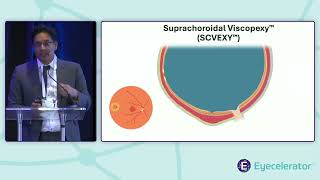 Eyecelerator Park City 2025 Retina Showcase Dragonfleye Therapeutics Corp
