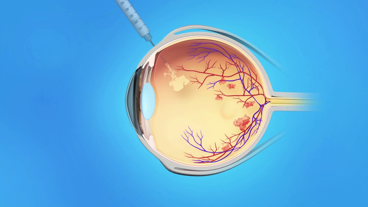 Diabetic Retinopathy  Macular Edema Spanish
