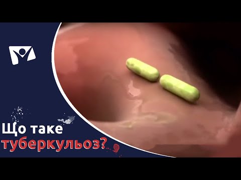 Що таке туберкульоз? Його профілактика та лікування | Вісті Надії