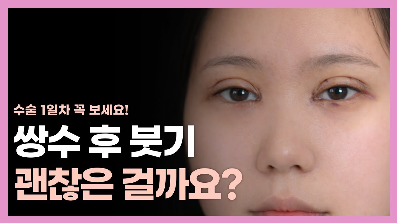 ★쌍꺼풀 수술 후 꼭 보세요★ 쌍수 후 붓기, 정말 괜찮을까?