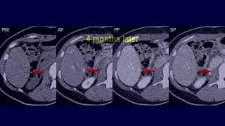 A Hypervascular Nodule In A Postoperative Hcc Patient