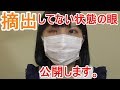 【閲覧注意】摘出してない右目について【義眼】