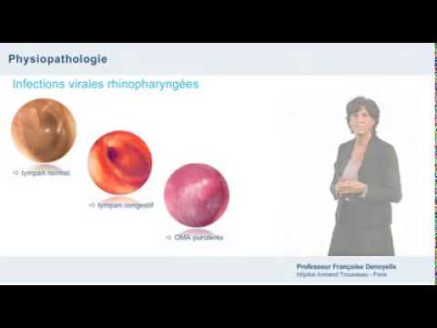 Vidéo: Otite Moyenne Aiguë: Causes, Symptômes Et Diagnostic