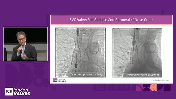 Cracking the tricuspid code "the Bicaval revolution" - PCR London Valves 2025