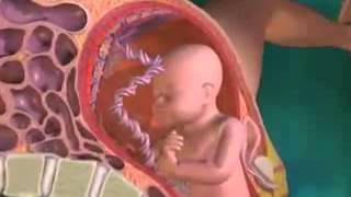 Diabète Gestationnel