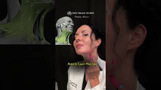 Botox to Jawline or upper portion of Platysma muscle is the best investment!  #facetransformation
