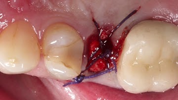 Physics Forceps Extraction, Osteogen Plug Graft, Hahn Dental Implants