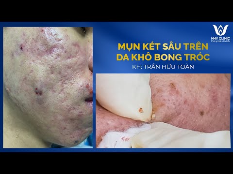 Video Mụn két sâu trên nền da khô bong tróc | HHV Clinic |... - youtube