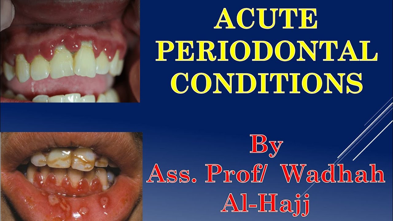15Periodontal diseases5(Acute periodontal infections)Dr Wadhah