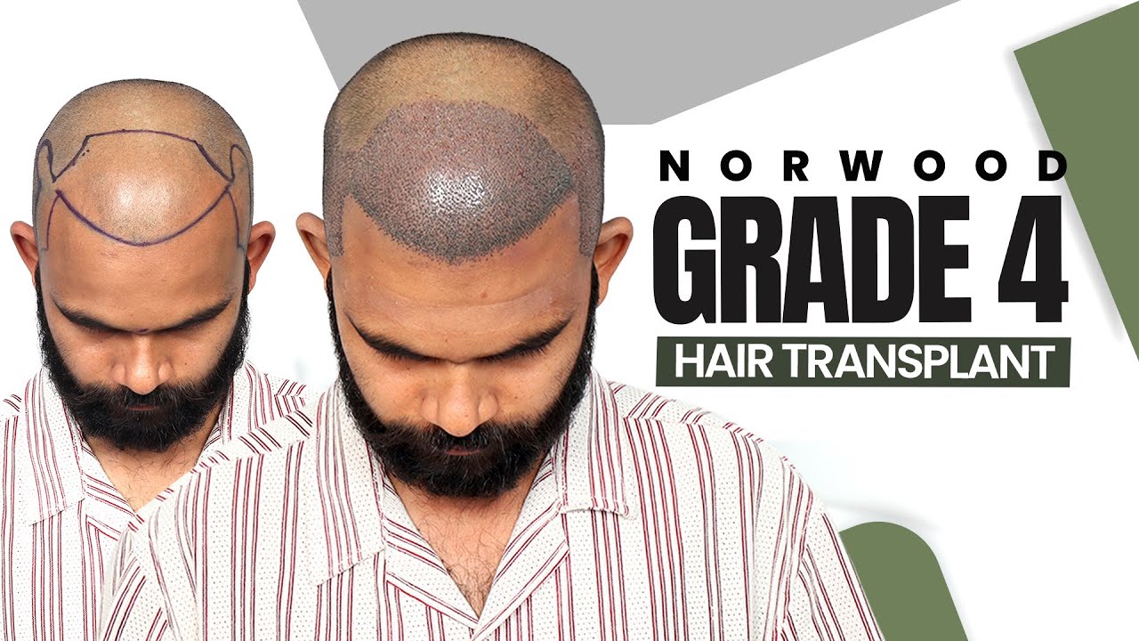 Best Hair Transplant in Jaipur (HX-NAGP) | Best Results & Cost of Hair Transplant in Jaipur.
