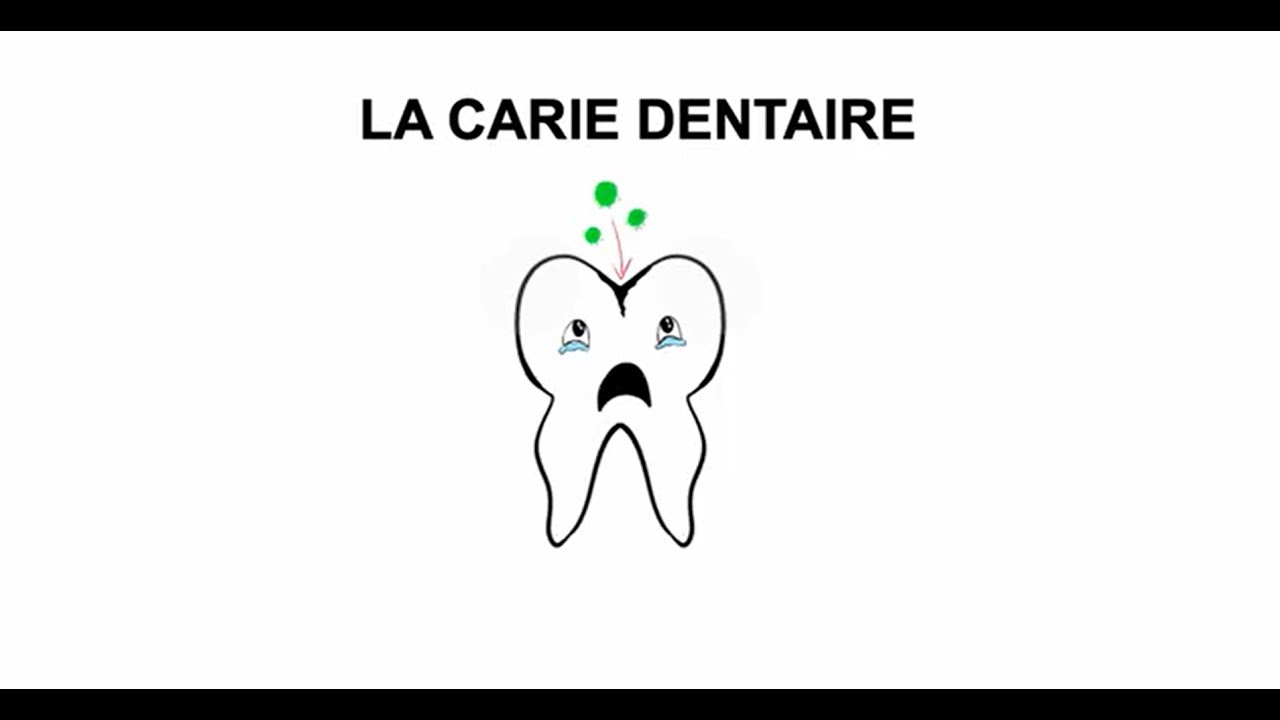 La carie dentaire