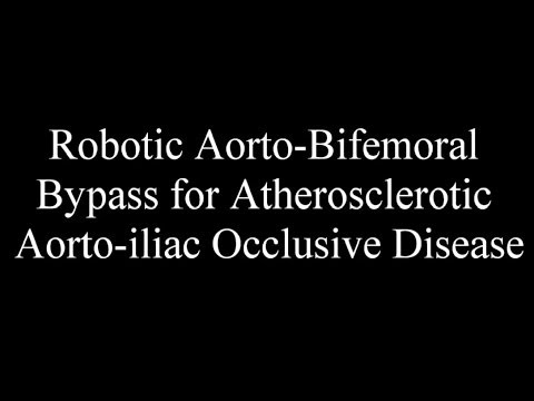 Video: Aortobifemoral Bypass: Kirurgi, Prosedyre Og Komplikasjoner