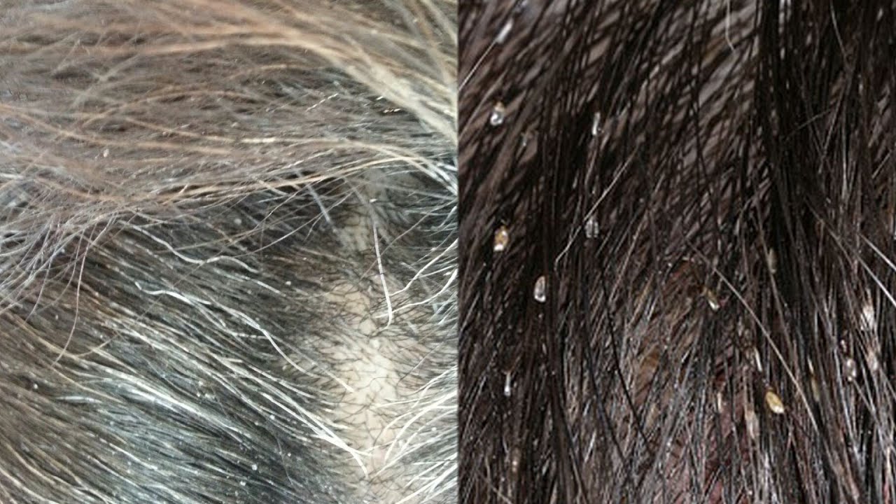 How Can I Tell If I Have Head Lice Or Dandruff YouTube