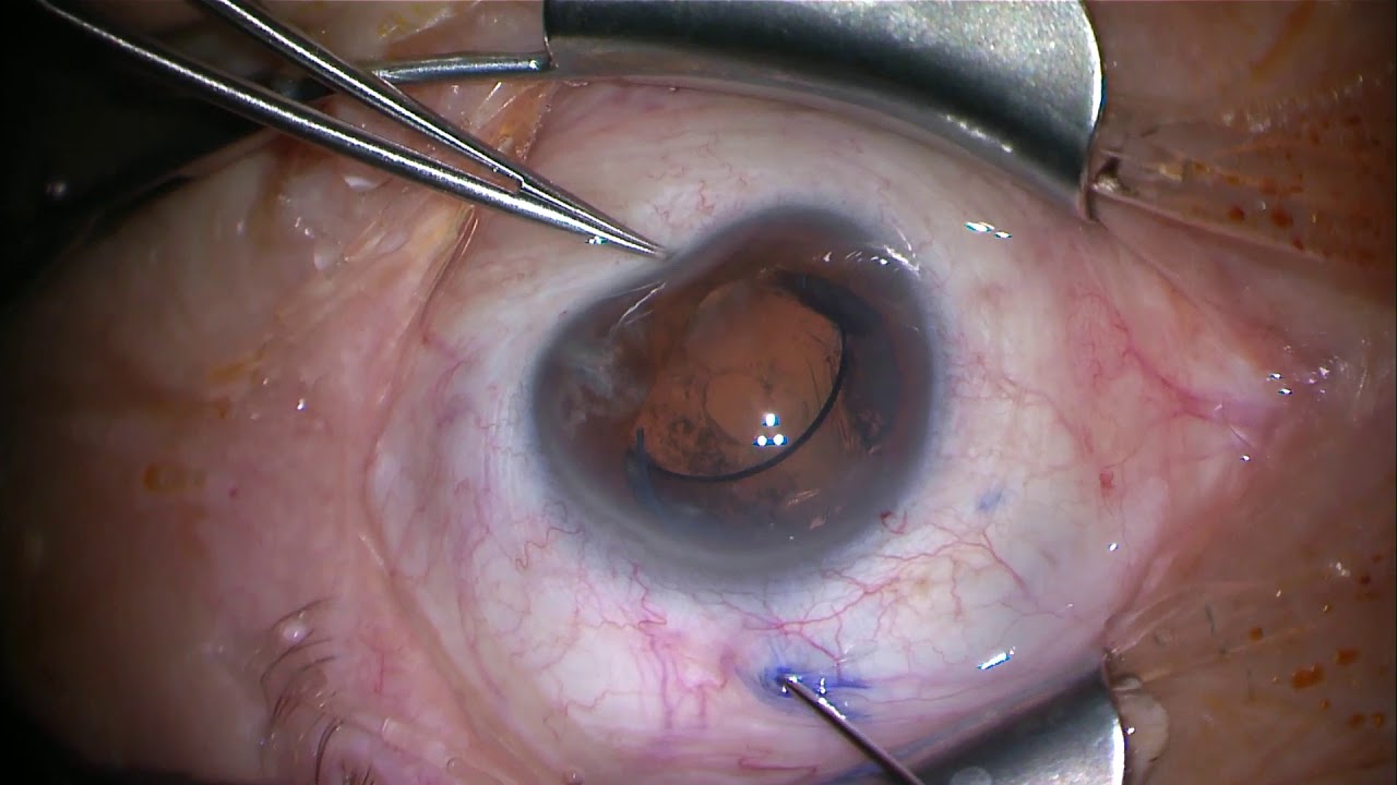 Nahtlose sklerale Fixation der Haptik einer dislozierten Intraokularlinse video editing software free