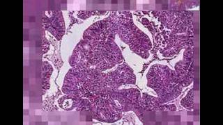 Histopathology UterusEndometrial adenocarcinoma