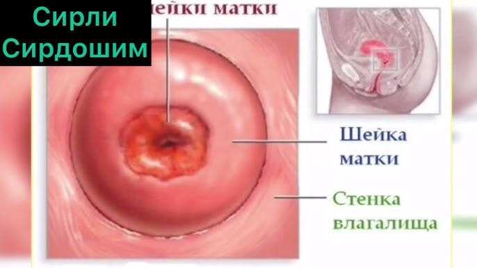 Anusdagi kokarishni davolash