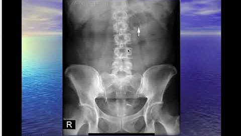 Tắc Ruột - BS Hiền - BV Việt Đức